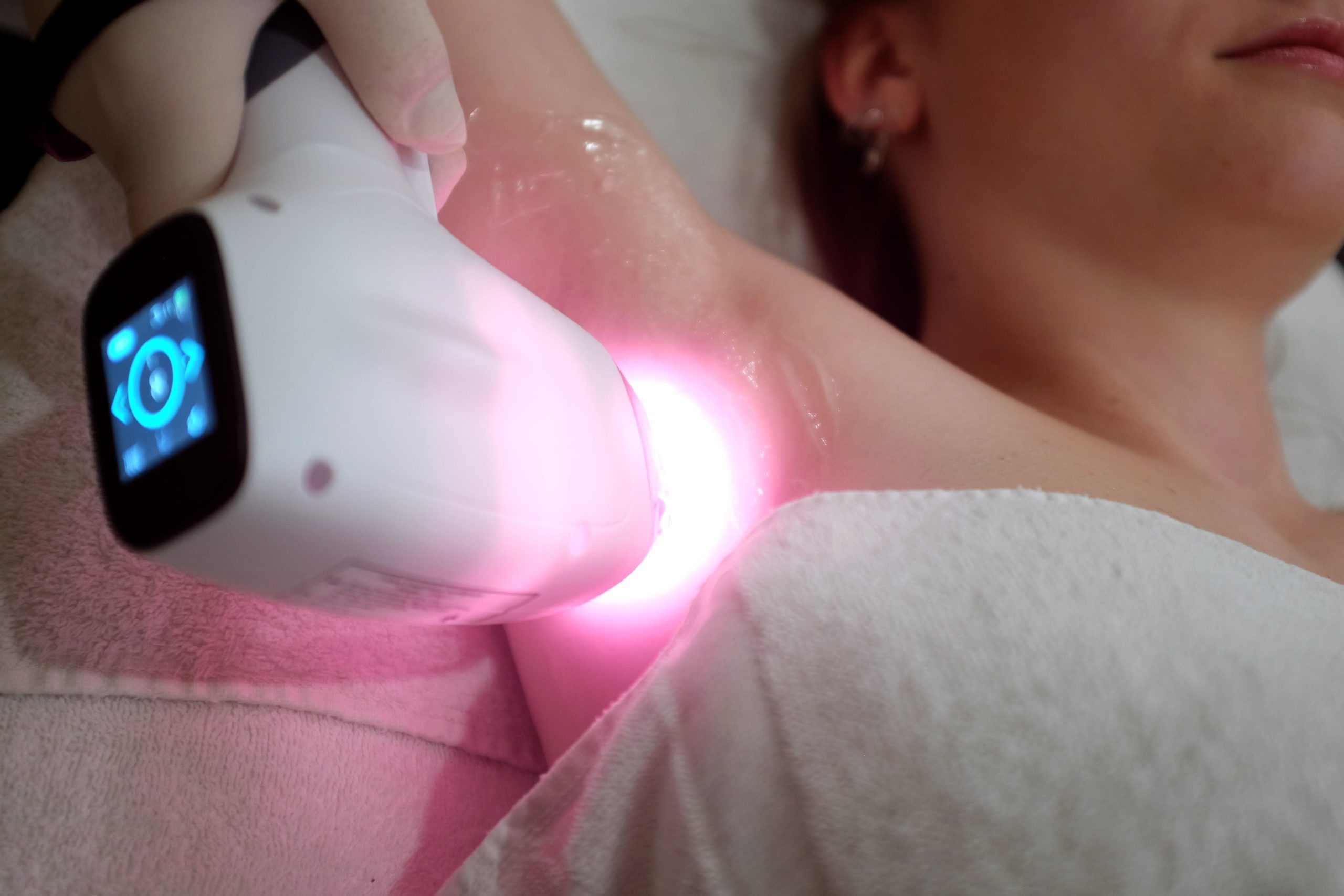 Epilation Laser